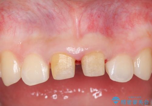 小さいころに前歯を折った がたがたの矯正+変色した前歯をセラミックにの治療中