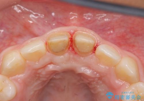 小さいころに前歯を折った がたがたの矯正+変色した前歯をセラミックにの治療中