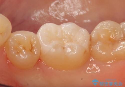 セラミックインレー しみる歯の歯の治療の治療後