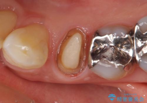 オールセラミッククラウン 疼きの治まらない歯の治療の治療中