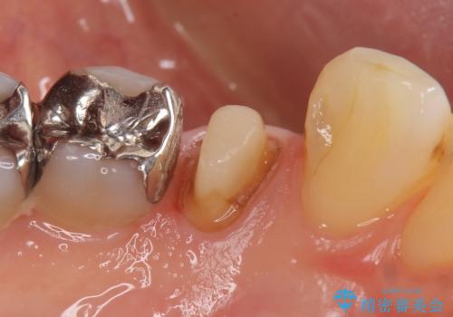 オールセラミッククラウン 疼きの治まらない歯の治療の治療中