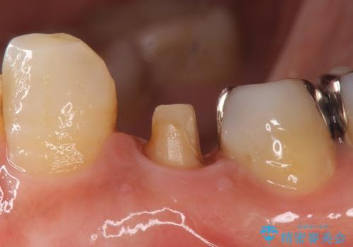オールセラミッククラウン 疼きの治まらない歯の治療の治療中