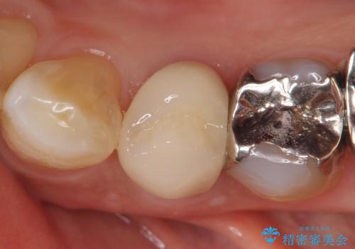 オールセラミッククラウン 疼きの治まらない歯の治療の治療後