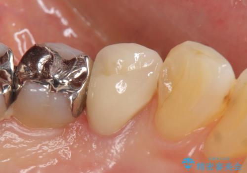 オールセラミッククラウン 疼きの治まらない歯の治療の治療後