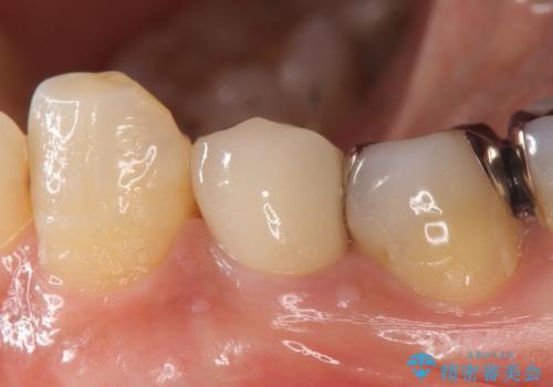 オールセラミッククラウン 疼きの治まらない歯の治療の治療後