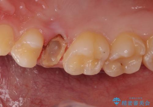 割れた歯を引っ張り出す　右上と左上の虫歯治療の症例 治療前