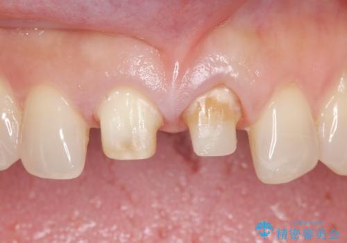 オールセラミッククラウン 変色が気になる前歯の治療の治療中