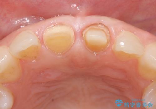 オールセラミッククラウン 変色が気になる前歯の治療の治療中