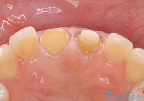 オールセラミッククラウン 変色が気になる前歯の治療の治療中