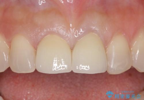 オールセラミッククラウン 変色が気になる前歯の治療の症例 治療後