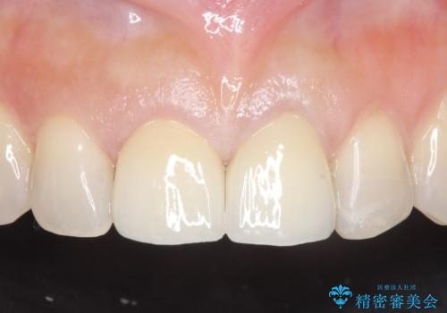 オールセラミッククラウン 変色が気になる前歯の治療の治療後