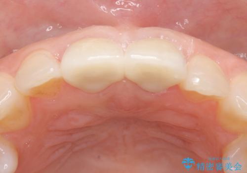 オールセラミッククラウン 変色が気になる前歯の治療の治療後