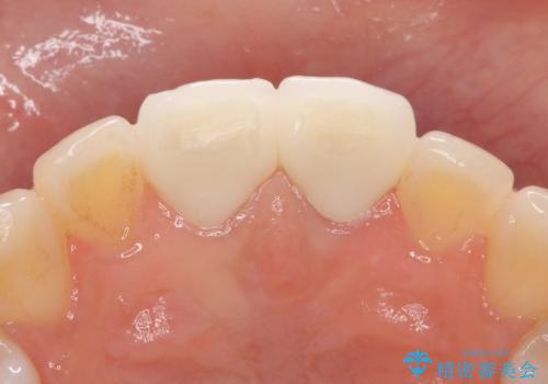 オールセラミッククラウン 変色が気になる前歯の治療の治療後