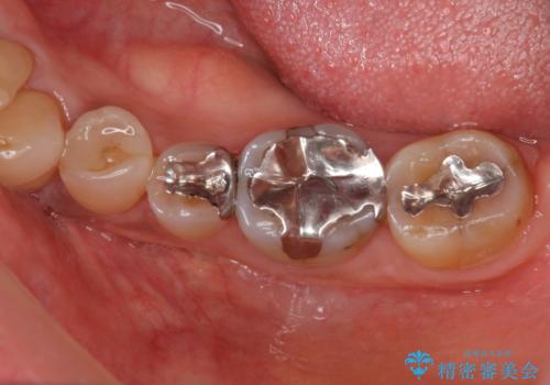 臼歯　咬合の再構成の治療前