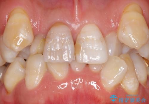奥に引っ込んでいる歯をセラミックでかぶせたい 補綴前矯正 50代男性の治療前