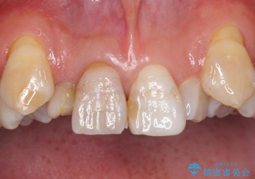 奥に引っ込んでいる歯をセラミックでかぶせたい 補綴前矯正 50代男性の治療前