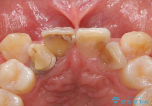 奥に引っ込んでいる歯をセラミックでかぶせたい 補綴前矯正 50代男性の治療前