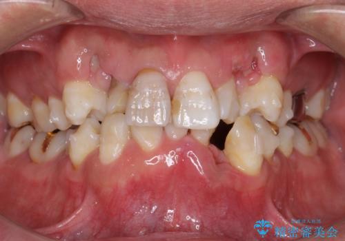 奥に引っ込んでいる歯をセラミックでかぶせたい 補綴前矯正 50代男性の治療中