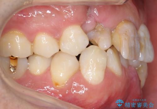 奥に引っ込んでいる歯をセラミックでかぶせたい 補綴前矯正 50代男性の治療中