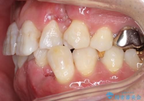 奥に引っ込んでいる歯をセラミックでかぶせたい 補綴前矯正 50代男性の治療中