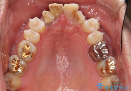 奥に引っ込んでいる歯をセラミックでかぶせたい 補綴前矯正 50代男性の治療中