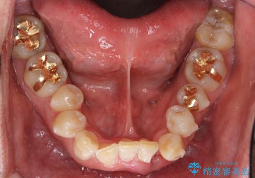 奥に引っ込んでいる歯をセラミックでかぶせたい 補綴前矯正 50代男性の治療中