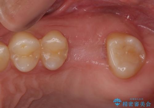 インビザライン矯正とインプラント補綴 深い咬み合わせと奥歯の欠損治療の治療前
