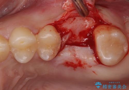 インビザライン矯正とインプラント補綴 深い咬み合わせと奥歯の欠損治療の治療中