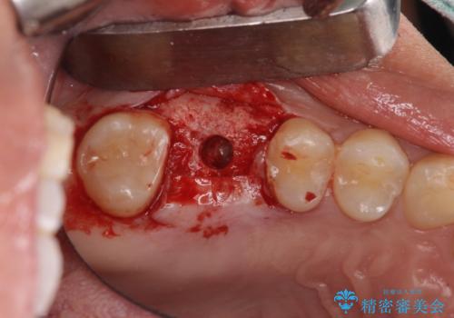 インビザライン矯正とインプラント補綴 深い咬み合わせと奥歯の欠損治療の治療後