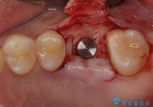 インビザライン矯正とインプラント補綴　深い咬み合わせと奥歯の欠損治療の治療中