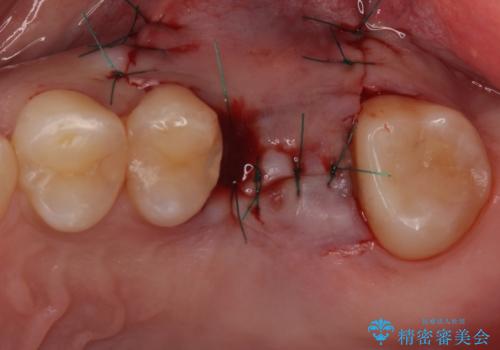 インビザライン矯正とインプラント補綴 深い咬み合わせと奥歯の欠損治療の治療中