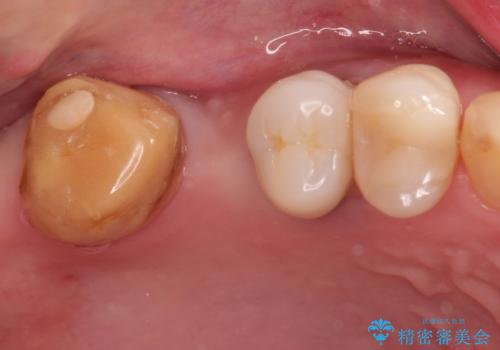 奥歯のオールセラミックブリッジの症例 治療前