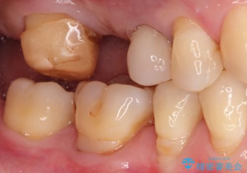 奥歯のオールセラミックブリッジの治療前