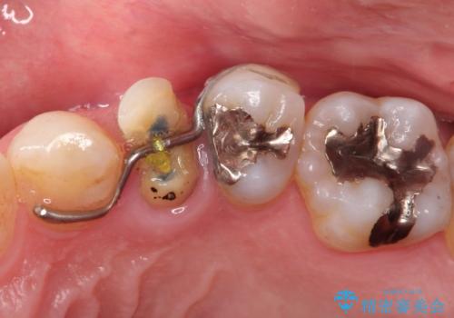 深いむし歯。根本的な治療の治療後