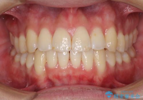 インビザラインで整った口元にの治療中