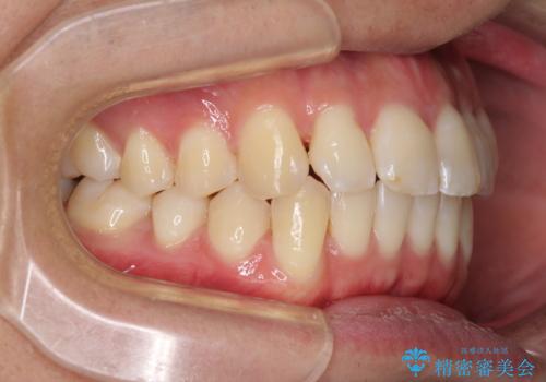 インビザラインで整った口元にの治療中