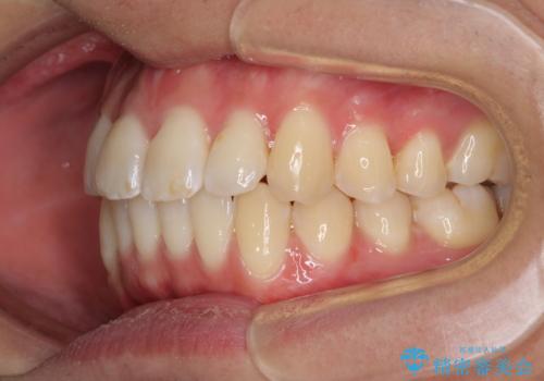 インビザラインで整った口元にの治療中