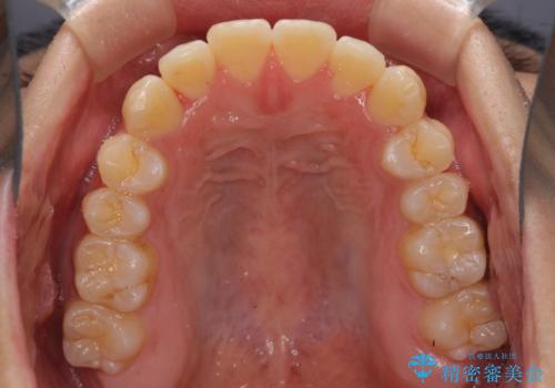 インビザラインで整った口元にの治療中