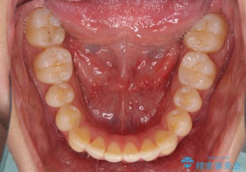 インビザラインで整った口元にの治療中