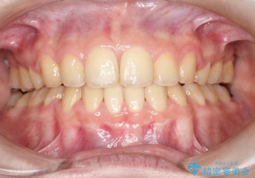 口元が出てるの気になる、引っ込めたい ワイヤーによる抜歯矯正で横顔の改善の治療後