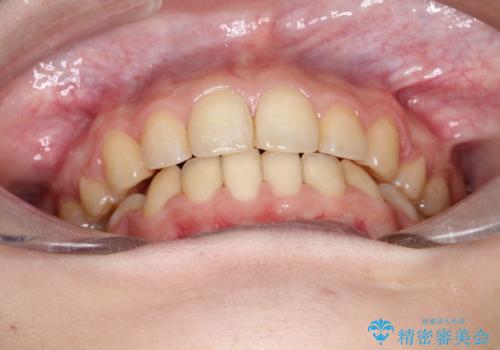 口元が出てるの気になる、引っ込めたい ワイヤーによる抜歯矯正で横顔の改善の治療後