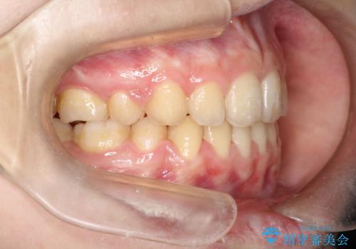 口元が出てるの気になる、引っ込めたい ワイヤーによる抜歯矯正で横顔の改善の治療後