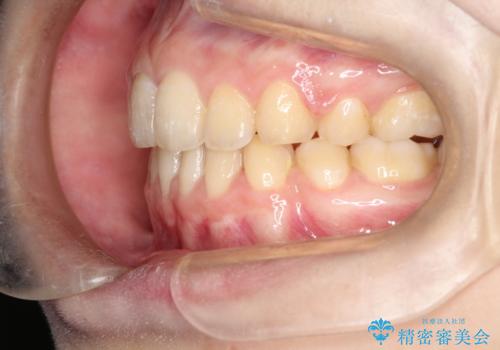 口元が出てるの気になる、引っ込めたい ワイヤーによる抜歯矯正で横顔の改善の治療後