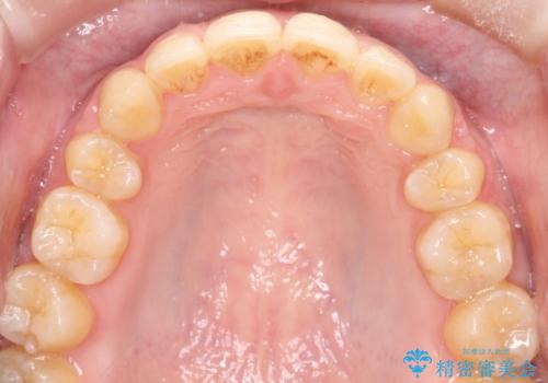 口元が出てるの気になる、引っ込めたい ワイヤーによる抜歯矯正で横顔の改善の治療後