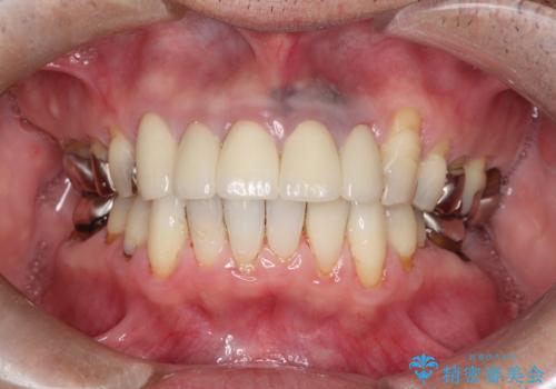 上の前歯の根元が黒い　根の治療を含めたセラミック再治療の治療後