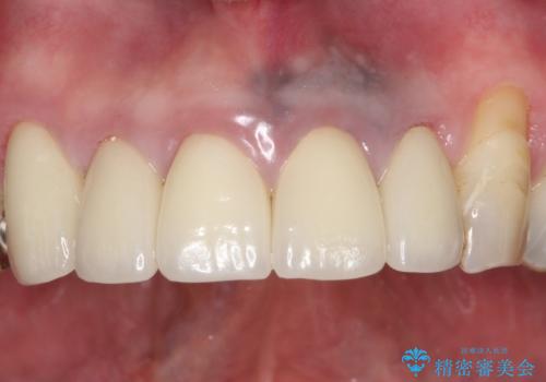 上の前歯の根元が黒い 根の治療を含めたセラミック再治療の治療後