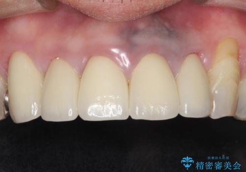 上の前歯の根元が黒い 根の治療を含めたセラミック再治療の治療後