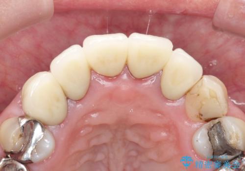 上の前歯の根元が黒い　根の治療を含めたセラミック再治療の治療後