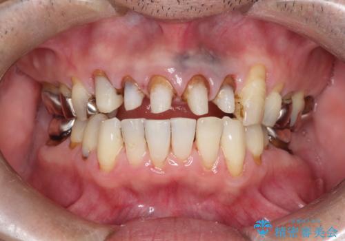 上の前歯の根元が黒い　根の治療を含めたセラミック再治療の治療中