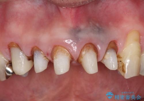 上の前歯の根元が黒い　根の治療を含めたセラミック再治療の治療中